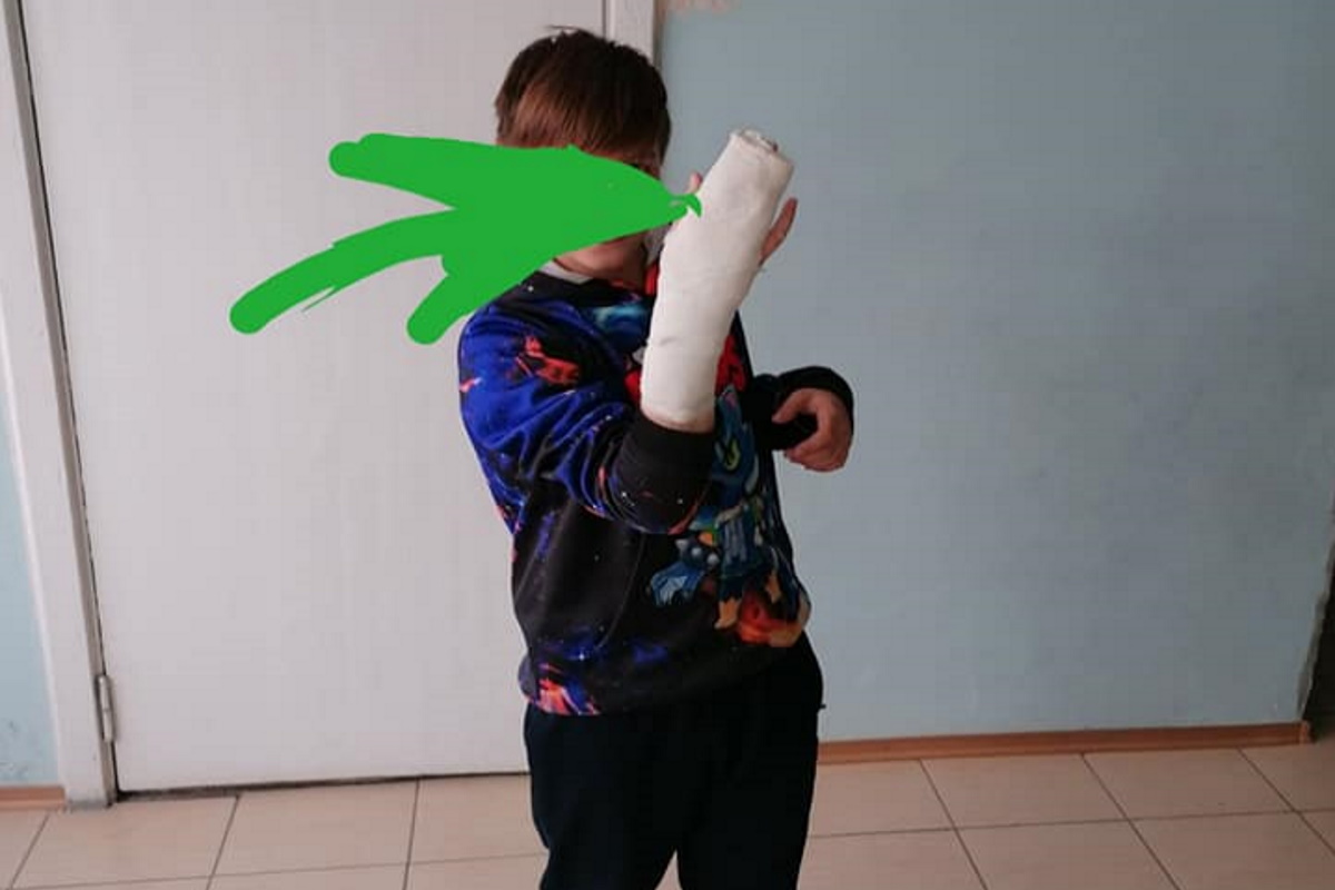 Последствие "квеста по-карачуновски". Мальчик сломал руку, упав в темноте.