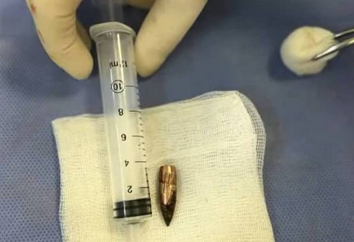 Хірургам вдалося витягнути кулю, що застрягла поряд зі спинним мозком Хірургам вдалося витягнути кулю, що застрягла поряд зі спинним мозком