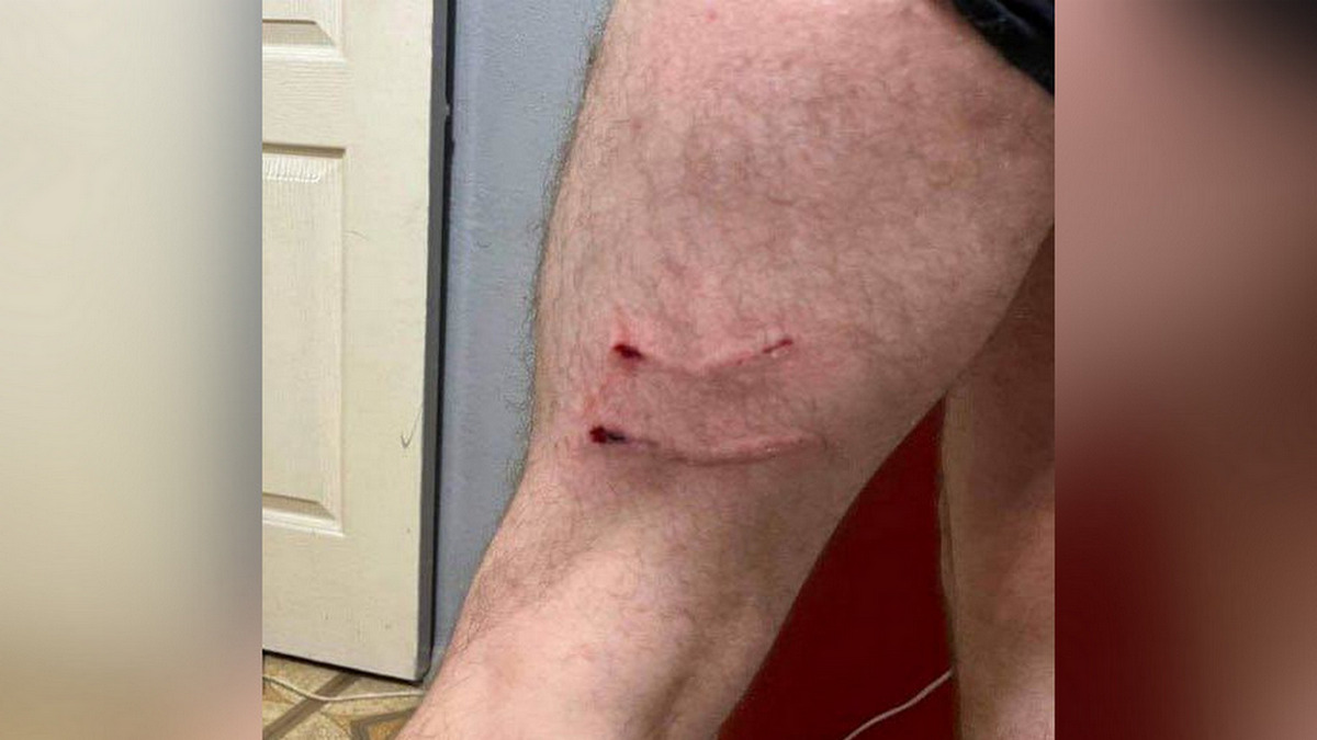 Згаря безпритульних собак покусала чоловіка