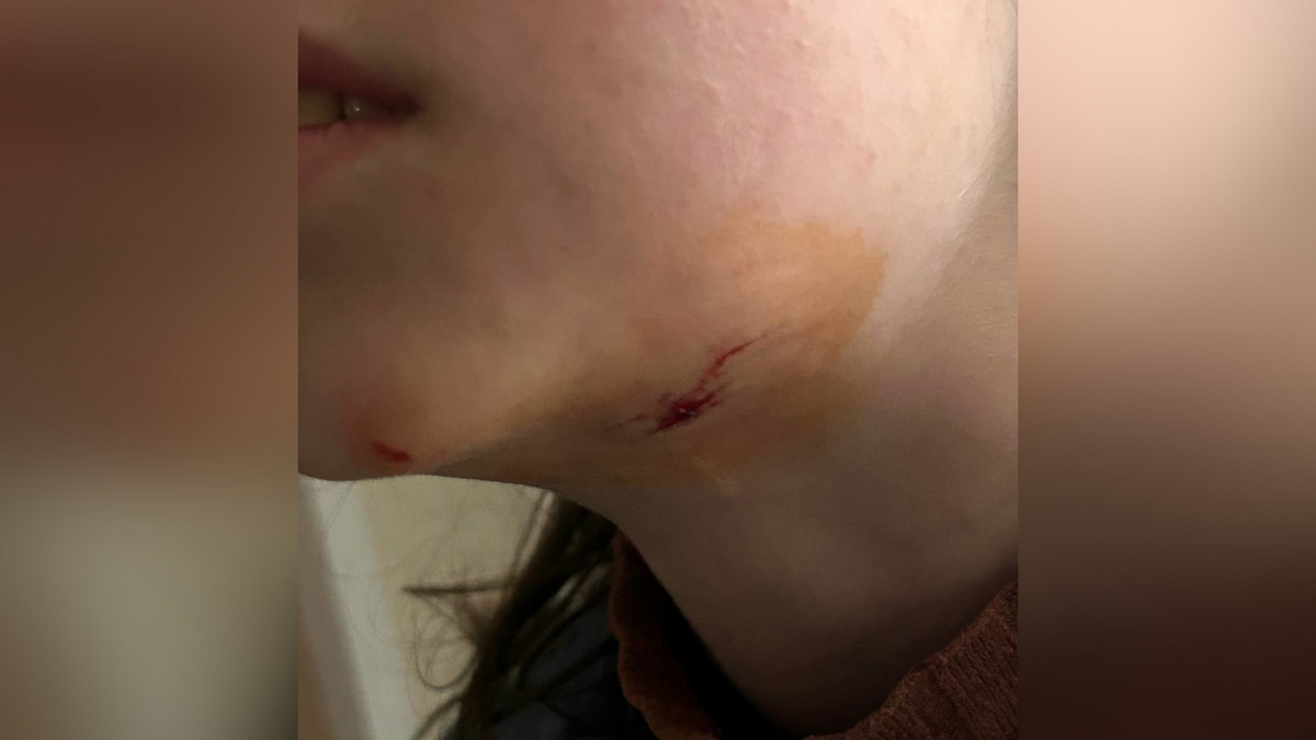 У Тернівському райні Кривого Рогу бродячий пес покусав дівчинку у  шию.